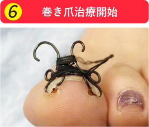 巻き爪治療開始